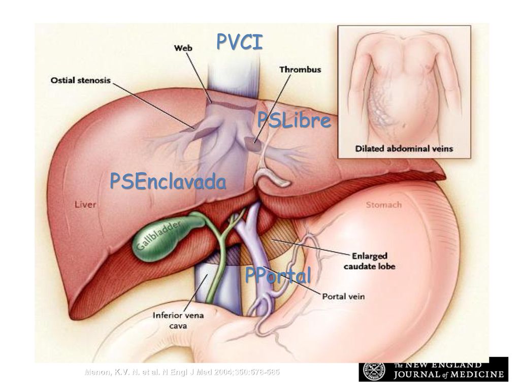 Caput medusae angioma venoso